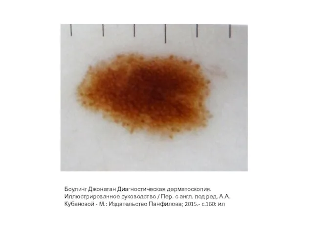 Боулинг Джонатан Диагностическая дерматоскопия. Иллюстрированное руководство / Пер. с англ. под ред.