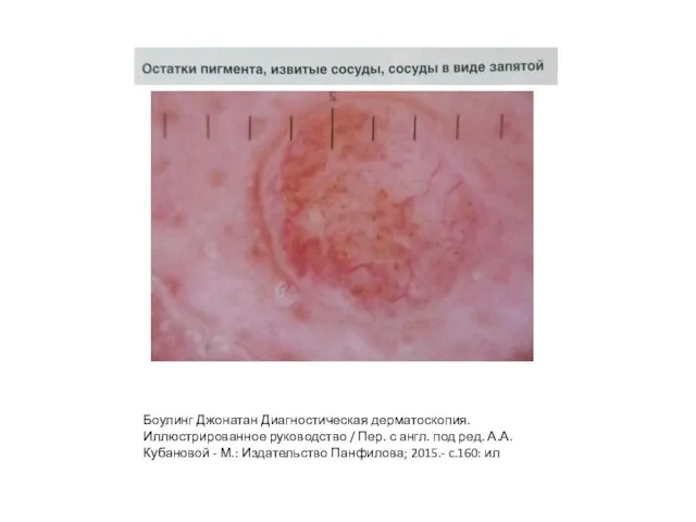 Боулинг Джонатан Диагностическая дерматоскопия. Иллюстрированное руководство / Пер. с англ. под ред.
