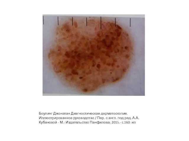 Боулинг Джонатан Диагностическая дерматоскопия. Иллюстрированное руководство / Пер. с англ. под ред.