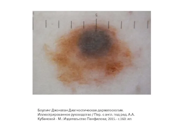 Боулинг Джонатан Диагностическая дерматоскопия. Иллюстрированное руководство / Пер. с англ. под ред.