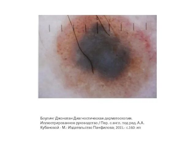 Боулинг Джонатан Диагностическая дерматоскопия. Иллюстрированное руководство / Пер. с англ. под ред.