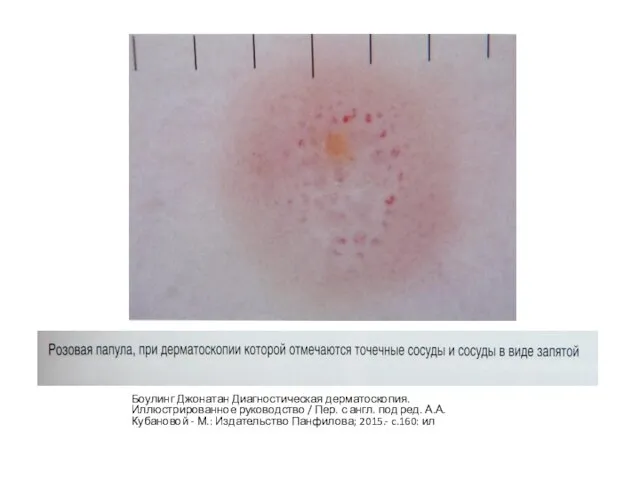 Боулинг Джонатан Диагностическая дерматоскопия. Иллюстрированное руководство / Пер. с англ. под ред.