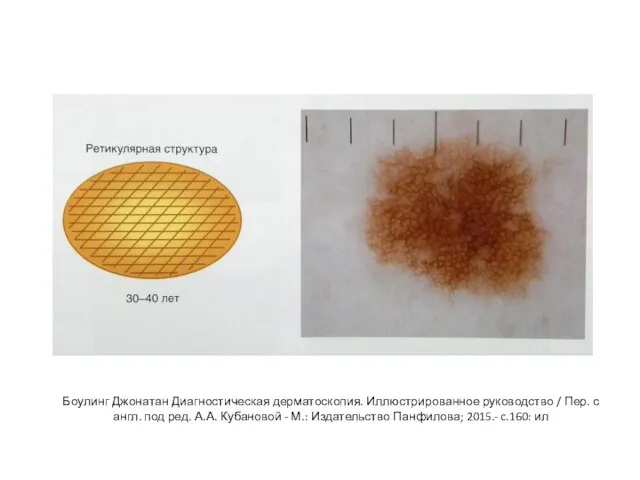 Боулинг Джонатан Диагностическая дерматоскопия. Иллюстрированное руководство / Пер. с англ. под ред.