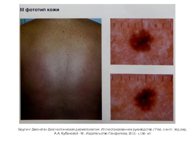 Боулинг Джонатан Диагностическая дерматоскопия. Иллюстрированное руководство / Пер. с англ. под ред.