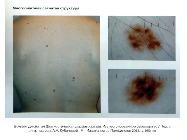 Боулинг Джонатан Диагностическая дерматоскопия. Иллюстрированное руководство / Пер. с англ. под ред.