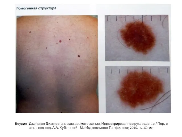 Боулинг Джонатан Диагностическая дерматоскопия. Иллюстрированное руководство / Пер. с англ. под ред.