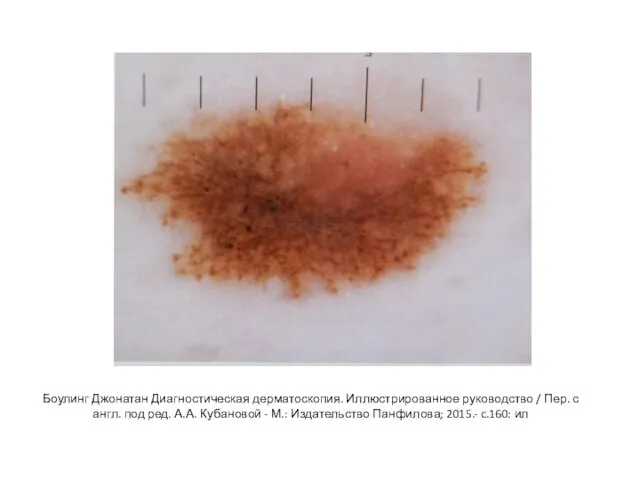 Боулинг Джонатан Диагностическая дерматоскопия. Иллюстрированное руководство / Пер. с англ. под ред.