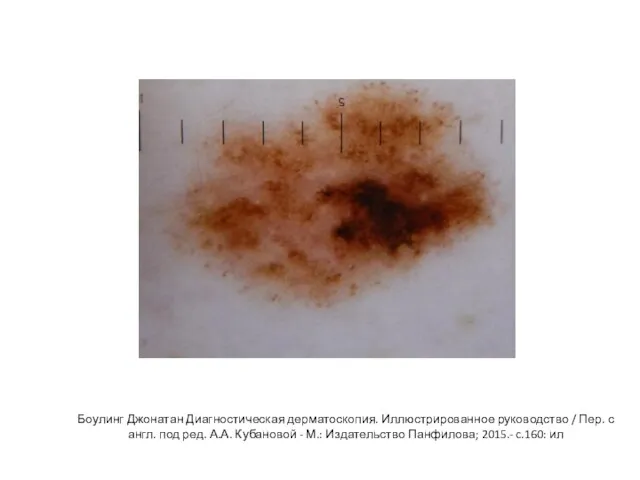 Боулинг Джонатан Диагностическая дерматоскопия. Иллюстрированное руководство / Пер. с англ. под ред.