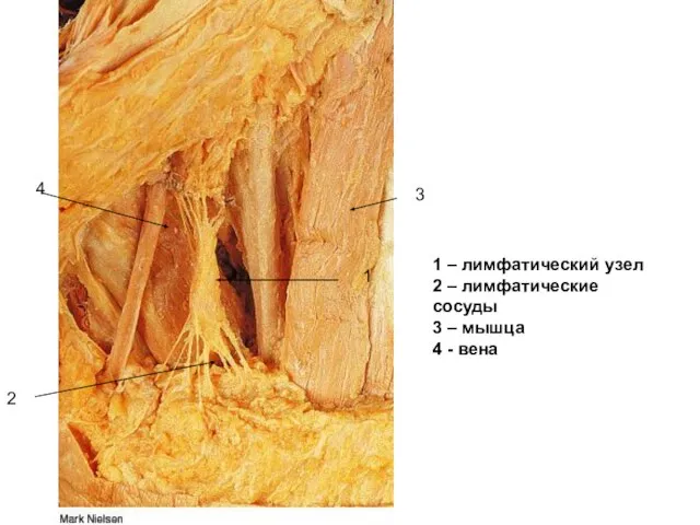1 3 2 4 1 – лимфатический узел 2 – лимфатические сосуды