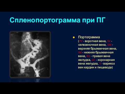 Спленопортограмма при ПГ Портограмма (PV - воротная вена, SV - селезеночная вена,