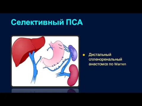 Селективный ПСА Дистальный спленоренальный анастомоз по Warren