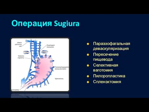 Операция Sugiura Параэзофагальная деваскуляризация Пересечение пищевода Селективная ваготомия Пилоропластика Спленэктомия