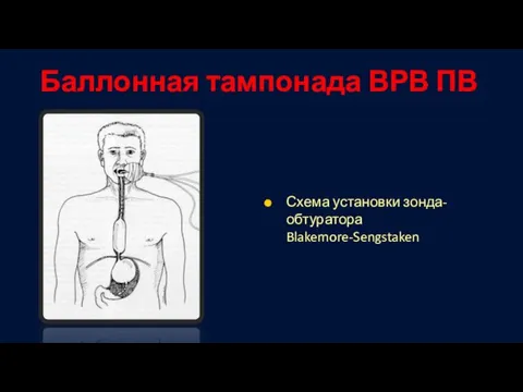 Баллонная тампонада ВРВ ПВ Схема установки зонда-обтуратора Blakemore-Sengstaken