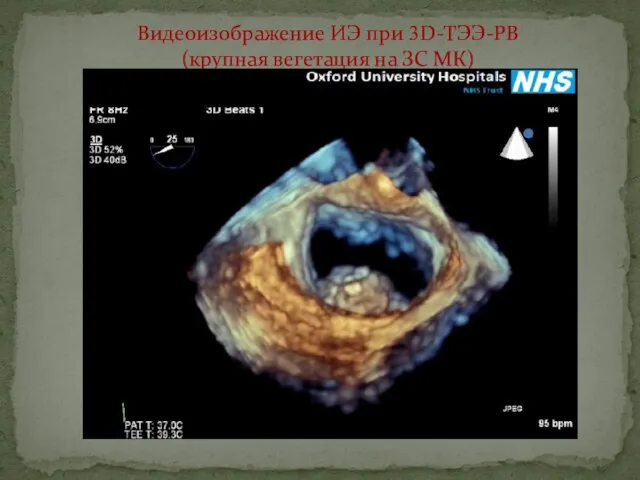 Видеоизображение ИЭ при 3D-ТЭЭ-РВ (крупная вегетация на ЗС МК)