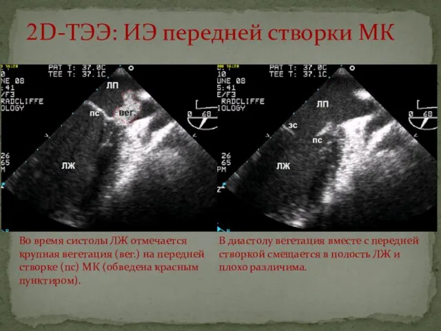 2D-ТЭЭ: ИЭ передней створки МК Во время систолы ЛЖ отмечается крупная вегетация