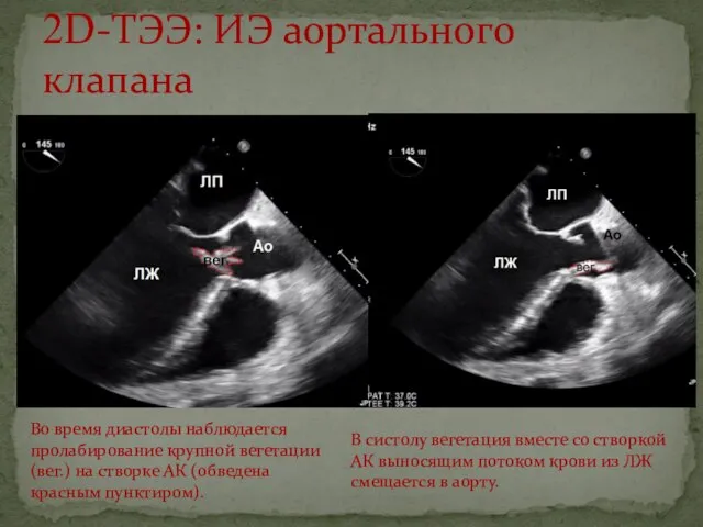 2D-ТЭЭ: ИЭ аортального клапана Во время диастолы наблюдается пролабирование крупной вегетации (вег.)