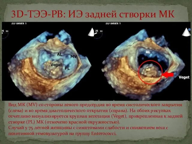 3D-ТЭЭ-РВ: ИЭ задней створки МК Вид МК (MV) со стороны левого предсердия