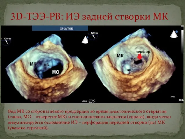 3D-ТЭЭ-РВ: ИЭ задней створки МК Вид МК со стороны левого предсердия во