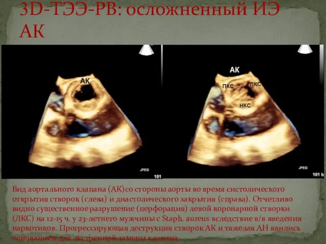 3D-ТЭЭ-РВ: осложненный ИЭ АК Вид аортального клапана (АК)со стороны аорты во время