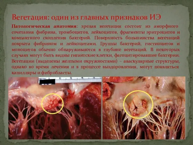 Вегетация: один из главных признаков ИЭ Патологическая анатомия: зрелая вегетация состоит из