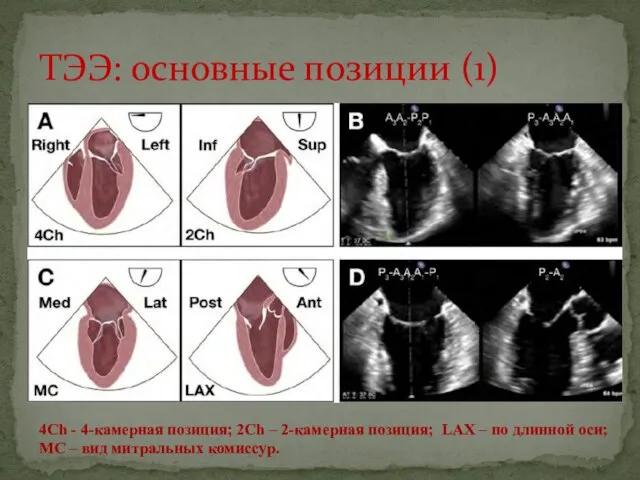 ТЭЭ: основные позиции (1) 4Сh - 4-камерная позиция; 2Ch – 2-камерная позиция;