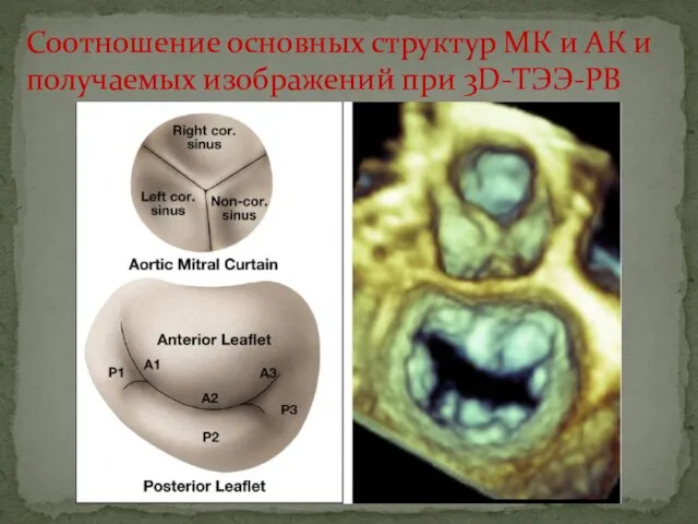 Соотношение основных структур МК и АК и получаемых изображений при 3D-ТЭЭ-РВ