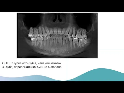 ОПТГ: скупченість зубів, наявний зачаток 38 зуба, периапікальних змін не виявлено.