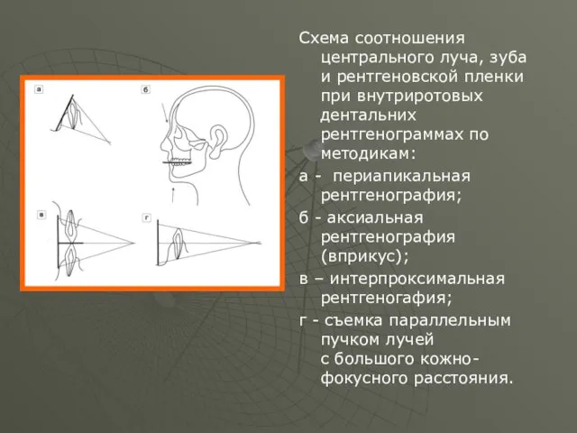 Схема соотношения центрального луча, зуба и рентгеновской пленки при внутриротовых дентальних рентгенограммах