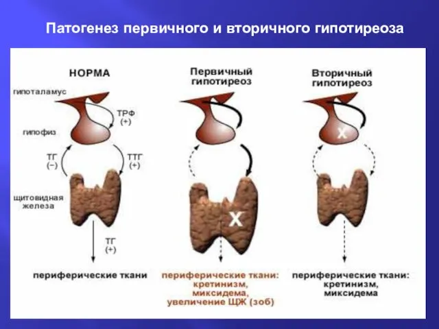 Патогенез первичного и вторичного гипотиреоза