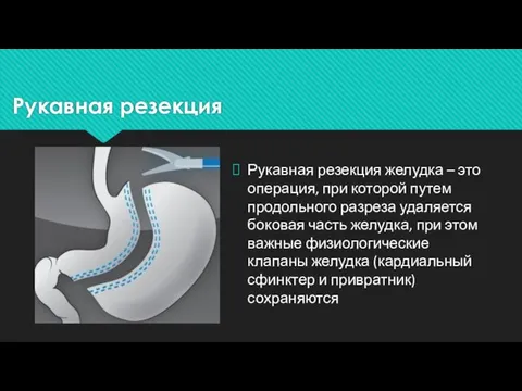 Рукавная резекция Рукавная резекция желудка – это операция, при которой путем продольного