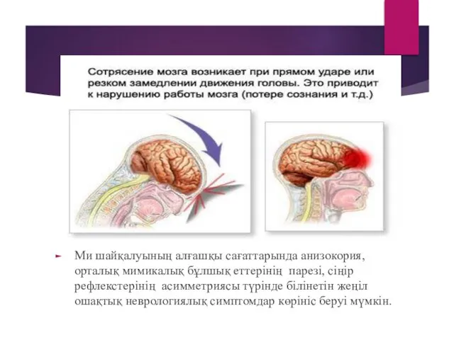 Ми шайқалуының алғашқы сағаттарында анизокория, орталық мимикалық бұлшық еттерінің парезі, сіңір рефлекстерінің