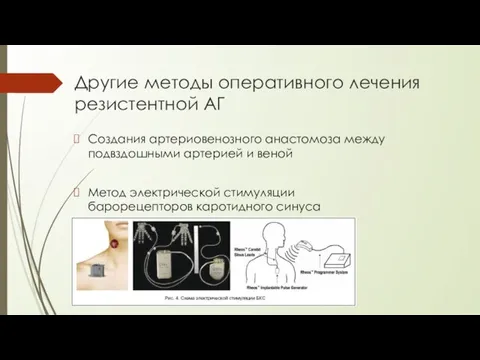 Другие методы оперативного лечения резистентной АГ Создания артериовенозного анастомоза между подвздошными артерией