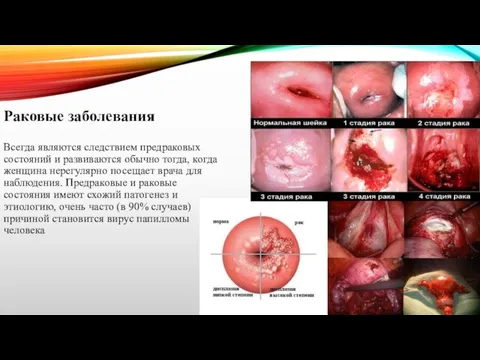 Раковые заболевания Всегда являются следствием предраковых состояний и развиваются обычно тогда, когда