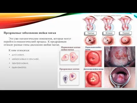 Предраковые заболевания шейки матки Это уже патологические изменения, которые могут перейти в