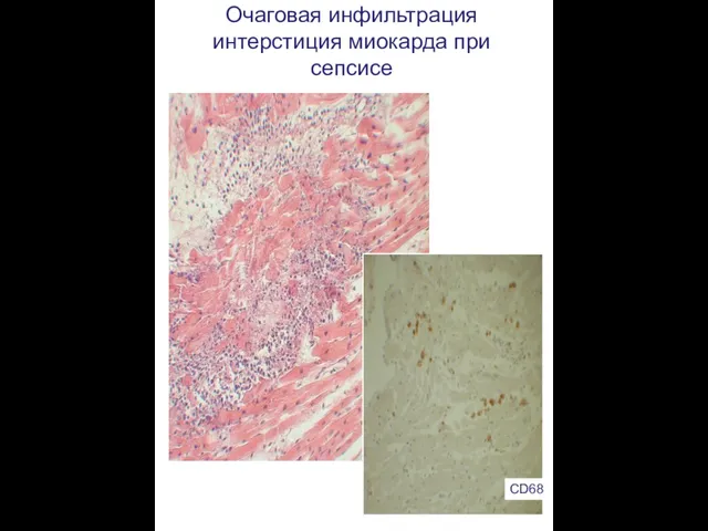 Очаговая инфильтрация интерстиция миокарда при сепсисе CD68