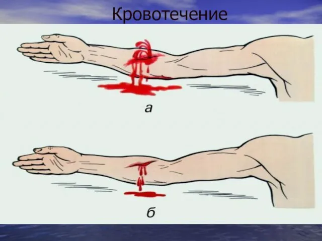 Кровотечение