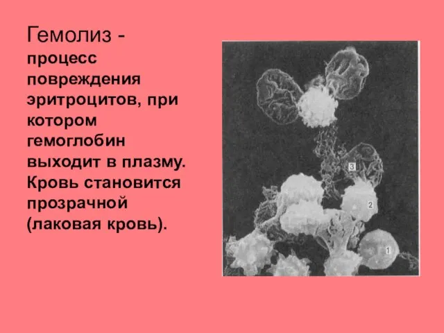 Гемолиз - процесс повреждения эритроцитов, при котором гемоглобин выходит в плазму. Кровь становится прозрачной (лаковая кровь).