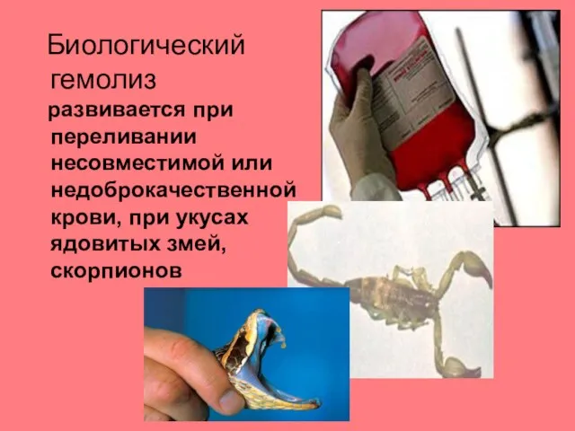 Биологический гемолиз развивается при переливании несовместимой или недоброкачественной крови, при укусах ядовитых змей, скорпионов