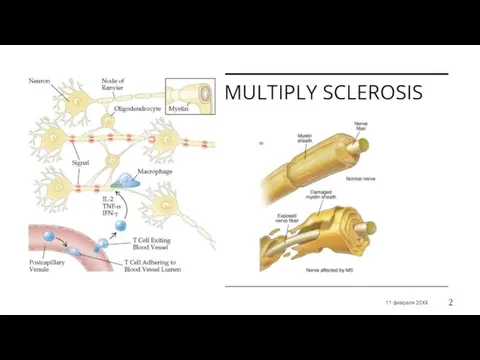 MULTIPLY SCLEROSIS ЗАГОЛОВОК ПРЕЗЕНТАЦИИ 11 февраля 20XX