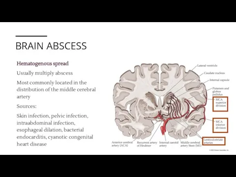 BRAIN ABSCESS 11 февраля 20XX Hematogenous spread Usually multiply abscess Most commonly