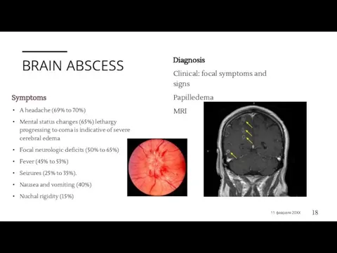 BRAIN ABSCESS Symptoms A headache (69% to 70%) Mental status changes (65%)
