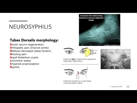 NEUROSYPHILIS 11 февраля 20XX