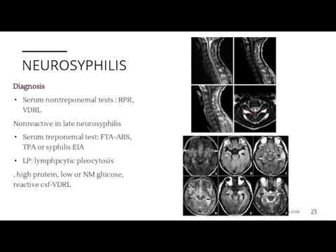 NEUROSYPHILIS Diagnosis Serum nontreponemal tests : RPR, VDRL Nonreactive in late neurosyphilis