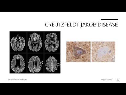 CREUTZFELDT-JAKOB DISEASE ЗАГОЛОВОК ПРЕЗЕНТАЦИИ 11 февраля 20XX