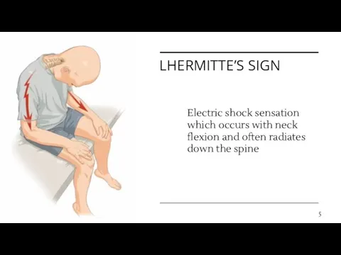LHERMITTE’S SIGN Electric shock sensation which occurs with neck flexion and often