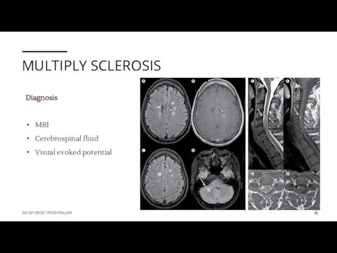 MULTIPLY SCLEROSIS Diagnosis MRI Cerebrospinal fluid Visual evoked potential ЗАГОЛОВОК ПРЕЗЕНТАЦИИ