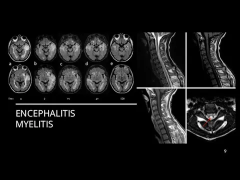 ENCEPHALITIS MYELITIS Multiply sclerosis Multiply sclerosis