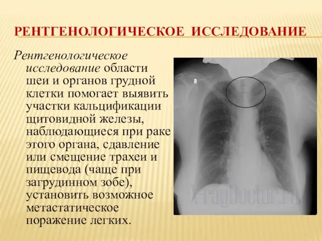 РЕНТГЕНОЛОГИЧЕСКОЕ ИССЛЕДОВАНИЕ Рентгенологическое исследование области шеи и органов грудной клетки помогает выявить