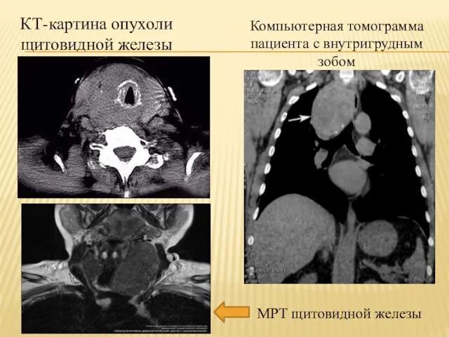 КТ-картина опухоли щитовидной железы Компьютерная томограмма пациента с внутригрудным зобом МРТ щитовидной железы