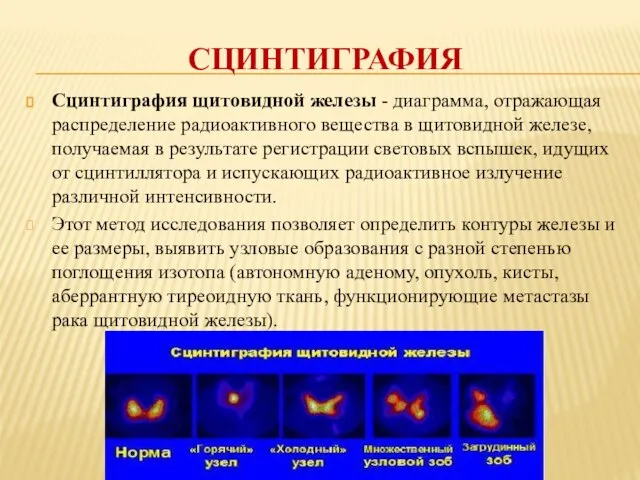 СЦИНТИГРАФИЯ Сцинтиграфия щитовидной железы - диаграмма, отражающая распределение радиоактивного вещества в щитовидной